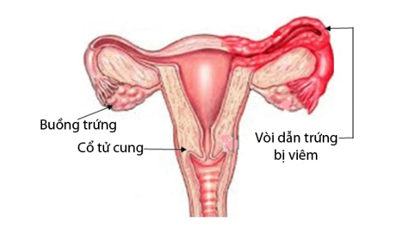 Viêm vòi trứng