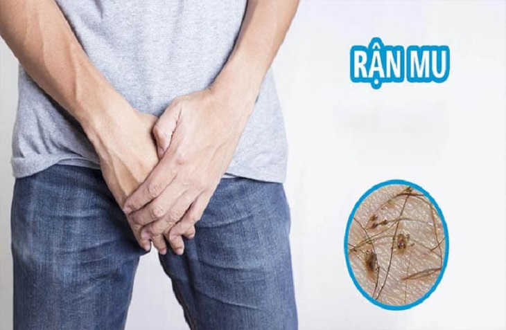 Ngứa vùng kín về đêm: Do mắc bệnh rận mu