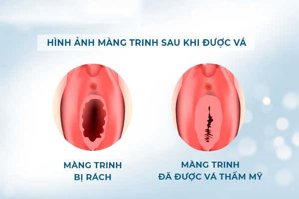 Vá màng trinh là gì