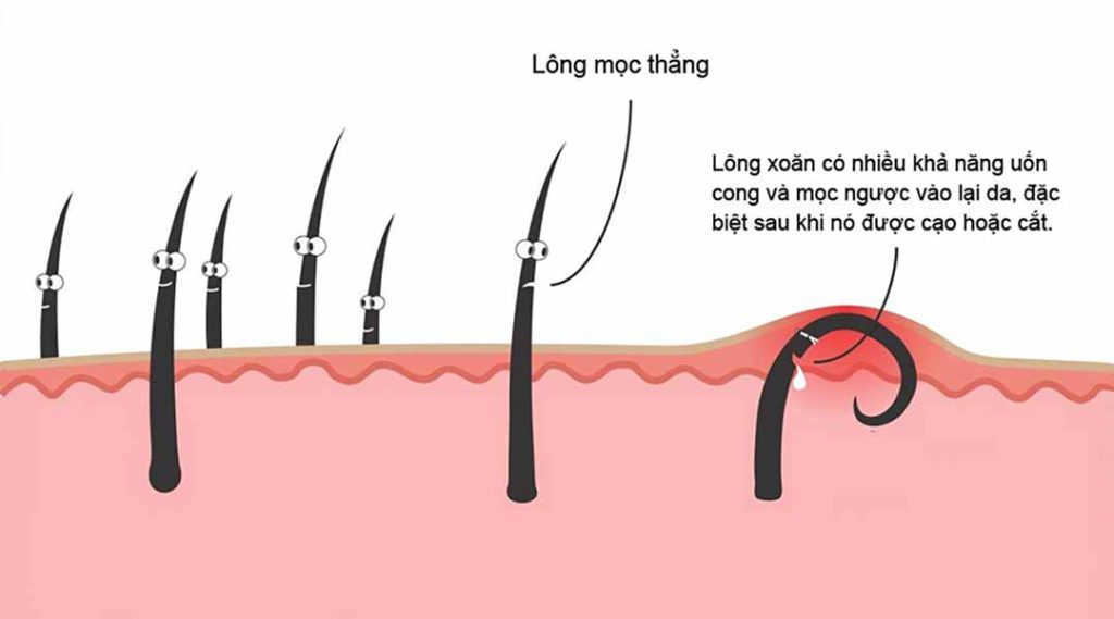Nguyên nhân viêm nang lông vùng kín