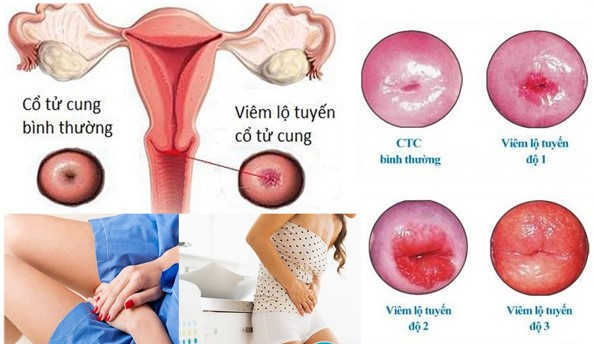 Điều cần biết về bệnh viêm lộ tuyến cổ tử cung