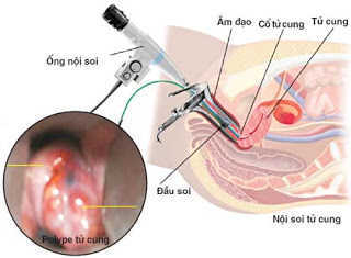 Đốt viêm lộ tuyến cổ tử cung