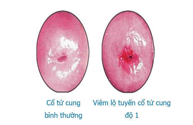 Viêm lộ tuyến cấp độ 1