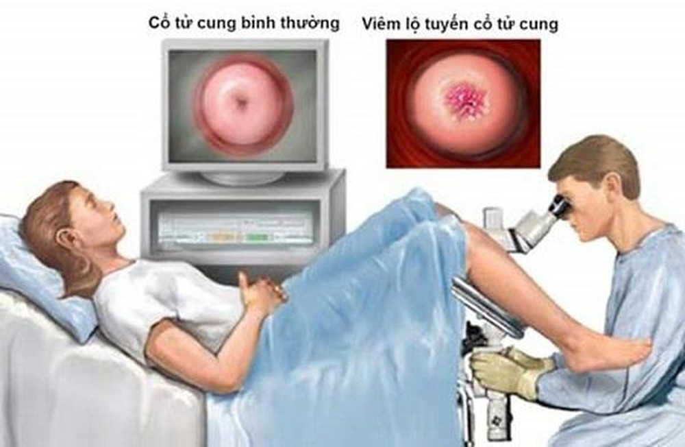 Đốt viêm lộ tuyến cổ tử cung