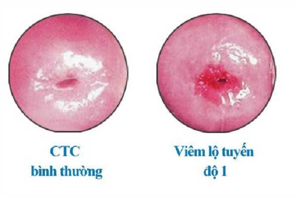 Viêm lộ tuyến cổ tử cung 1cm