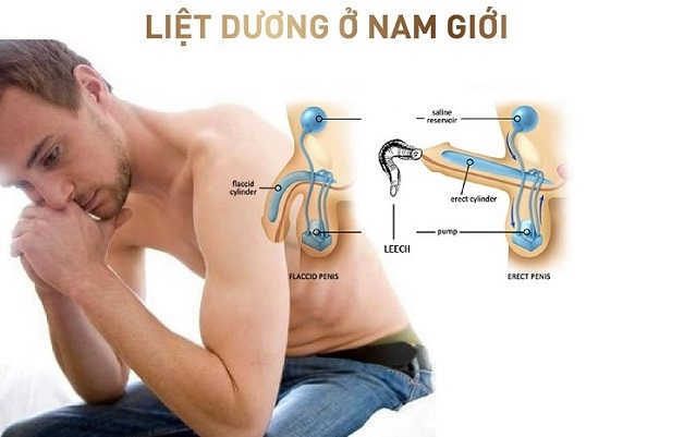 Liệt dương là gì?