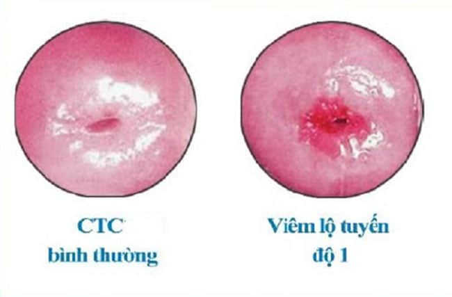 viêm lộ tuyến độ 1