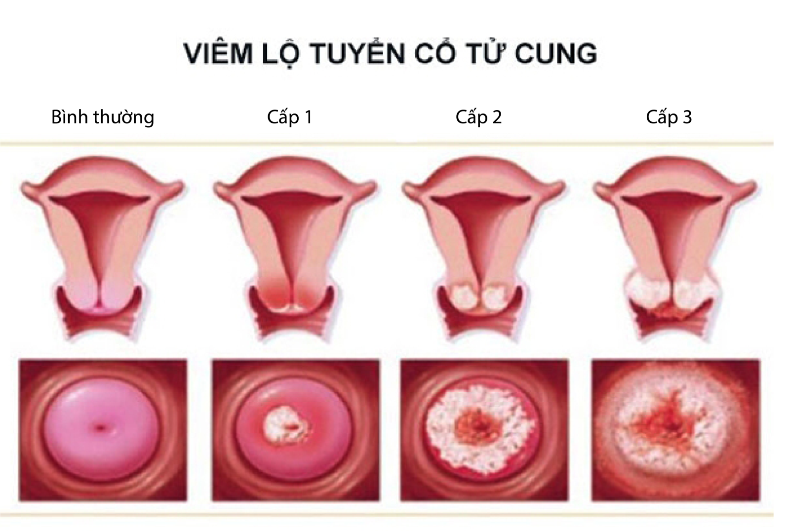 Các cấp độ viêm lộ tuyến cổ tử cung