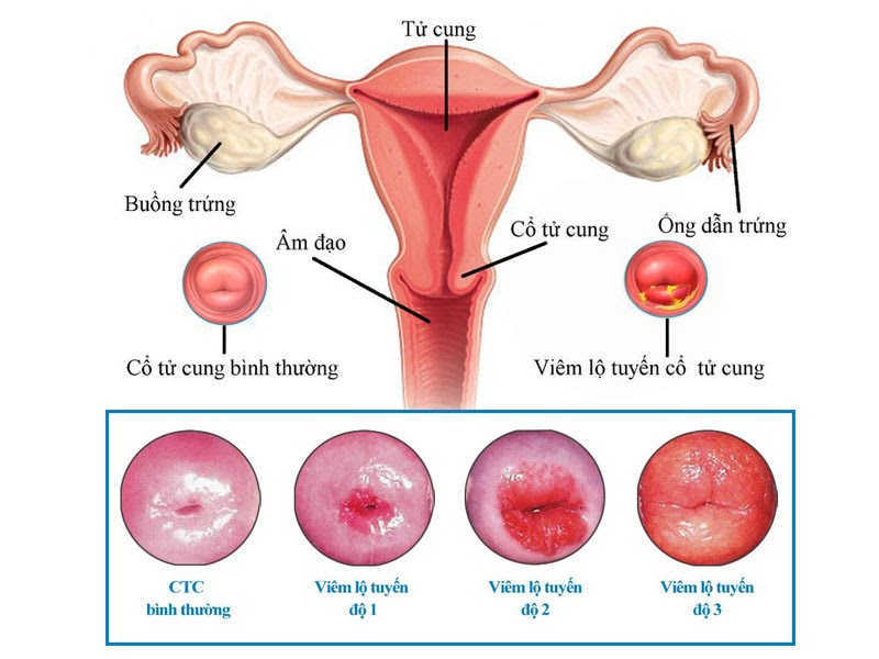 Bệnh viêm lộ tuyến cổ tử cung