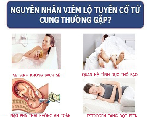 Nguyên nhân gây bệnh viêm lộ tuyến