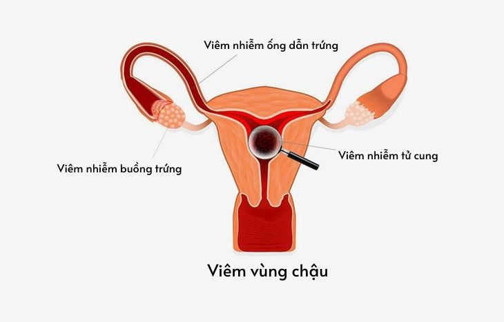 Viêm vùng chậu 