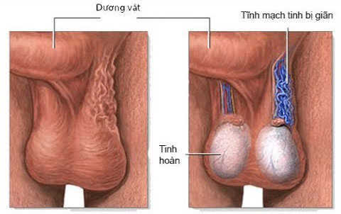 Giãn tĩnh mạch thừng tinh